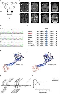 DNM1L-Related Mitochondrial Fission Defects Presenting as Encephalopathy: A Case Report and Literature Review